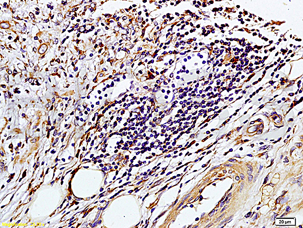 Formalin-fixed and paraffin embedded human colon carcinoma labeled with Rabbit Anti-TIMP-1(NT) Polyclonal Antibody, Unconjugated(bs-0415R) at 1:200 followed by conjugation to the secondary antibody and DAB staining.