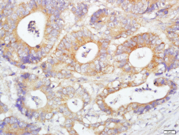 Paraformaldehyde-fixed, paraffin embedded human colon carcinoma; Antigen retrieval by boiling in sodium citrate buffer (pH6.0) for 15min; Block endogenous peroxidase by 3% hydrogen peroxide for 20 minutes; Blocking buffer (normal goat serum) at 37°C for 30min; Antibody incubation with Glutaredoxin 2 Polyclonal Antibody, Unconjugated bs-13394R at 1:500 overnight at 4°C, followed by a conjugated secondary (sp-0023) for 20 minutes and DAB staining.