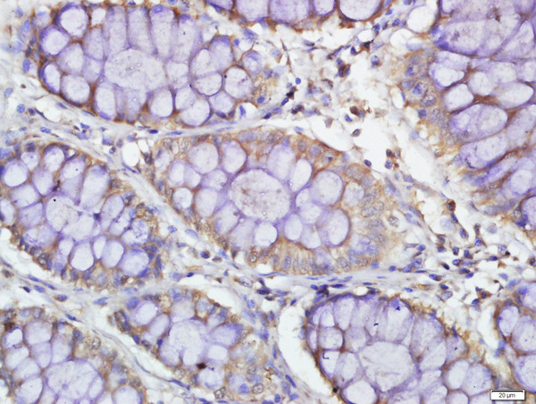 Paraformaldehyde-fixed, paraffin embedded human colon carcinoma; Antigen retrieval by boiling in sodium citrate buffer (pH6.0) for 15min; Block endogenous peroxidase by 3% hydrogen peroxide for 20 minutes; Blocking buffer (normal goat serum) at 37°C for 30min; Antibody incubation with PDE7B Polyclonal Antibody, Unconjugated (bs-11576R) at 1:500 overnight at 4°C, followed by a conjugated secondary for 20 minutes and DAB staining.