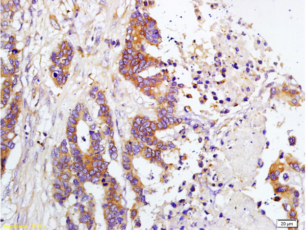 Formalin-fixed and paraffin embedded human colon carcinoma labeled with Rabbit Anti-TIMP-1(NT) Polyclonal Antibody, Unconjugated(bs-0415R) at 1:200 followed by conjugation to the secondary antibody and DAB staining.