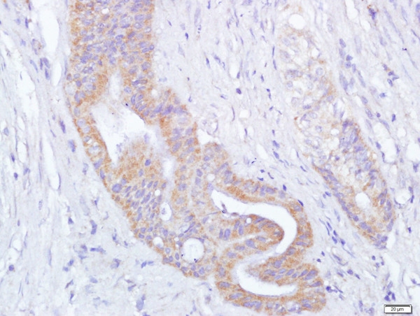 Paraformaldehyde-fixed, paraffin embedded human cervical carcinoma; Antigen retrieval by boiling in sodium citrate buffer (pH6.0) for 15min; Block endogenous peroxidase by 3% hydrogen peroxide for 20 minutes; Blocking buffer (normal goat serum) at 37°C for 30min; Antibody incubation with Thioredoxin Polyclonal Antibody, Unconjugated (bs-0458R) at 1:400 overnight at 4°C, followed by a conjugated secondary for 20 minutes and DAB staining.