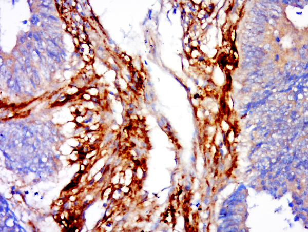 Formalin-fixed and paraffin embedded human colon cancer labeled with CHPF Polyclonal Antibody, Unconjugated (bs-13928R) at 1:200 followed by conjugation to the secondary antibody and DAB staining