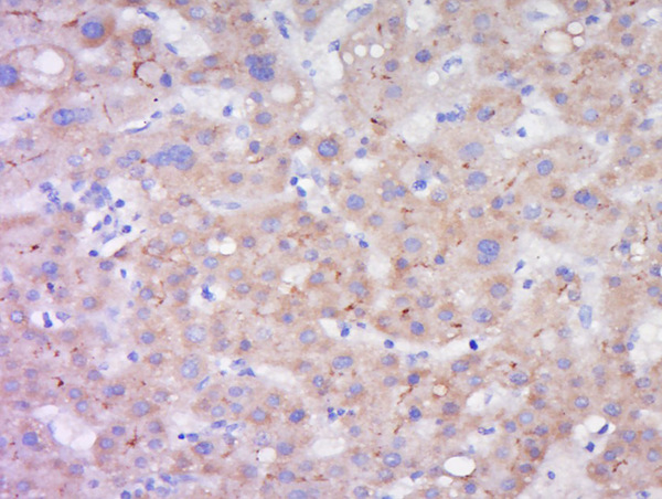 Paraformaldehyde-fixed, paraffin embedded human liver carcinoma; Antigen retrieval by boiling in sodium citrate buffer (pH6) for 15min; Block endogenous peroxidase by 3% hydrogen peroxide for 30 minutes; Blocking buffer (BSA or normal goat serum) at 37°C for 20min; Antibody incubation with LIPC Polyclonal Antibody, Unconjugated (bs-18288R) at 1:200 overnight at 4°C, followed by a conjugated secondary (sp-0023) for 20 minutes and DAB staining.