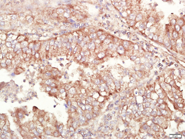 Paraformaldehyde-fixed, paraffin embedded human lung carcinoma tissue; Antigen retrieval by boiling in sodium citrate buffer(pH6) for 15min; Block endogenous peroxidase by 3% hydrogen peroxide for 30 minutes; Blocking buffer (normal goat serum) at 37°C for 20min; Antibody incubation with Rabbit Anti-ALDH1 Polyclonal Antibody, Unconjugated (bs-10162R) at 1:400 overnight at 4°C, followed by a conjugated secondary and DAB staining