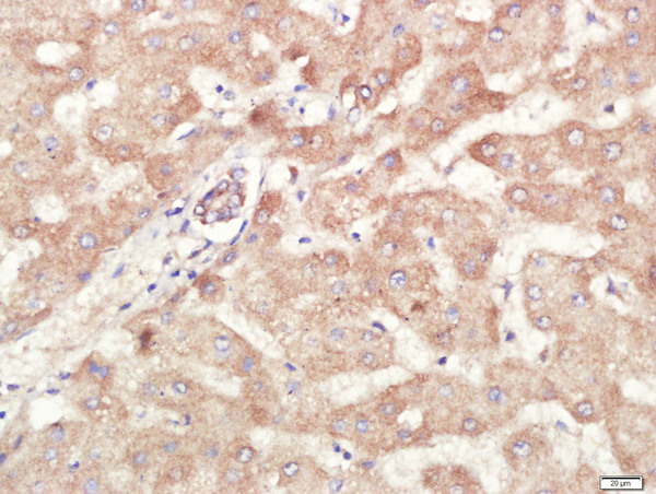 Paraformaldehyde-fixed, paraffin embedded human liver carcinoma tissue; Antigen retrieval by boiling in sodium citrate buffer(pH6) for 15min; Block endogenous peroxidase by 3% hydrogen peroxide for 30 minutes; Blocking buffer (normal goat serum) at 37°C for 20min; Antibody incubation with Rabbit Anti-ALDH1 Polyclonal Antibody, Unconjugated (bs-10162R) at 1:400 overnight at 4°C, followed by a conjugated secondary and DAB staining
