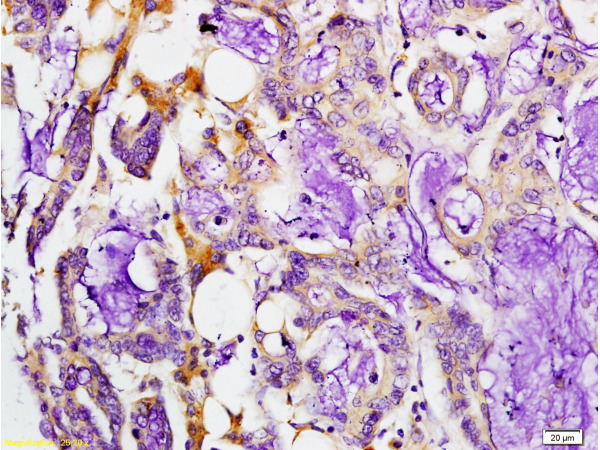 Formalin-fixed and paraffin embedded human colon carcinoma labeled with Rabbit Anti-MMP-7 Polyclonal Antibody, Unconjugated(bs-0423R) at 1:200 followed by conjugation to the secondary antibody and DAB staining.