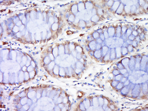 Paraformaldehyde-fixed, paraffin embedded human colon cancer; Antigen retrieval by boiling in sodium citrate buffer (pH6) for 15min; Block endogenous peroxidase by 3% hydrogen peroxide for 30 minutes; Blocking buffer (BSA or normal goat serum) at 37°C for 20min; Antibody incubation with Rad51 Polyclonal Antibody, Unconjugated (bs-20297R) at 1:200 overnight at 4°C, followed by a conjugated secondary (sp-0023) for 20 minutes and DAB staining. Paraformaldehyde-fixed, paraffin embedded human colon cancer; Antigen retrieval by boiling in sodium citrate buffer (pH6) for 15min; Block endogenous peroxidase by 3% hydrogen peroxide for 30 minutes; Blocking buffer (BSA or normal goat serum) at 37°C for 20min; Antibody incubation with Rad51 Polyclonal Antibody, Unconjugated (bs-20297R) at 1:200 overnight at 4°C, followed by a conjugated secondary (sp-0023) for 20 minutes and DAB staining.