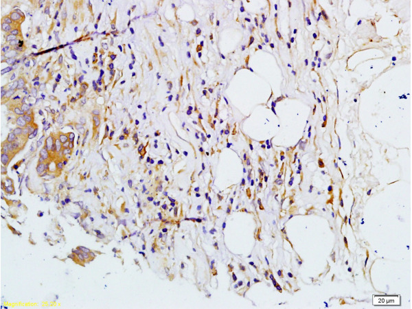 Formalin-fixed and paraffin embedded human colon carcinoma labeled with Rabbit Anti-MMP-7 Polyclonal Antibody, Unconjugated (bs-0423R) at 1:200 followed by conjugation to the secondary antibody and DAB staining.