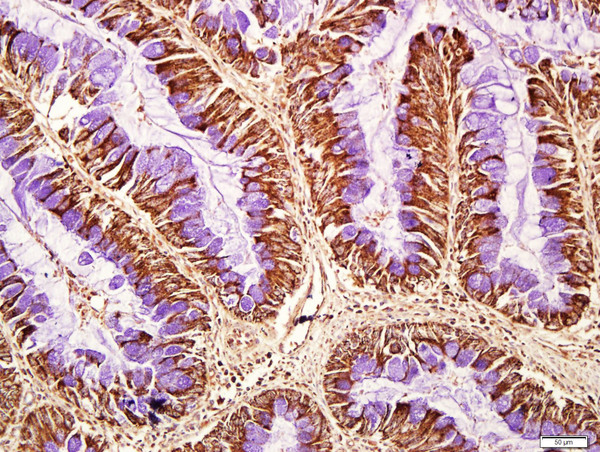 Paraformaldehyde-fixed, paraffin embedded human colon carcinoma tissue; Antigen retrieval by boiling in sodium citrate buffer(pH6) for 15min; Block endogenous peroxidase by 3% hydrogen peroxide for 30 minutes; Blocking buffer (normal goat serum) at 37°C for 20min; Antibody incubation with Rabbit Anti-CD8B Polyclonal Antibody, Unconjugated (bs-4914R) at 1:400 overnight at 4°C, followed by a conjugated secondary and DAB staining