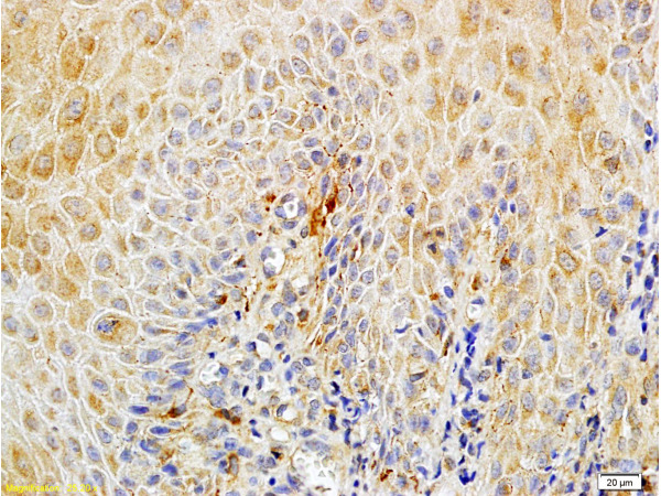 Formalin-fixed and paraffin embedded human endometrium carcinoma labeled with Rabbit Anti-Matriptase Polyclonal Antibody (bs-0531R), Unconjugated at 1:100 followed by conjugation to the secondary antibody and DAB staining.