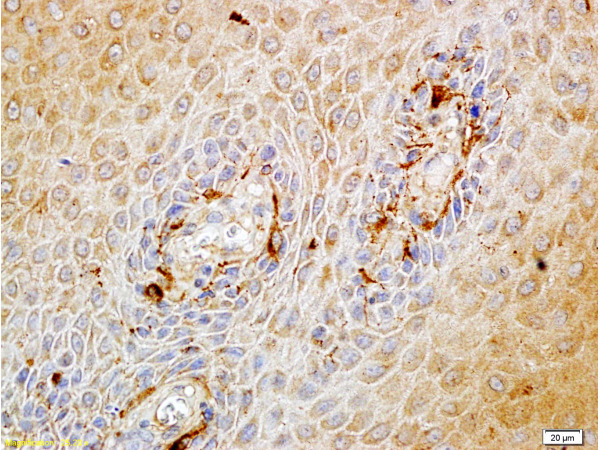 Formalin-fixed and paraffin embedded human endometrium carcinoma labeled with Rabbit Anti-Matriptase Polyclonal Antibody(bs-0531R), Unconjugated  at 1:100 followed by conjugation to the secondary antibody and DAB staining.