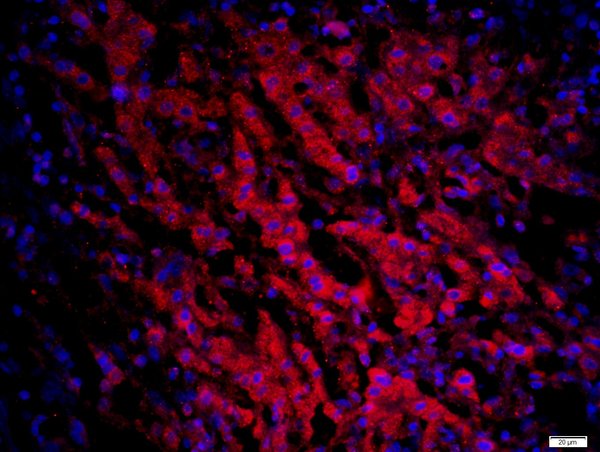 Paraformaldehyde-fixed, paraffin embedded human liver cancer; Antigen retrieval by boiling in sodium citrate buffer (pH6) for 15min; Block endogenous peroxidase by 3% hydrogen peroxide for 20 minutes; Blocking buffer (normal goat serum) at 37°C for 30min; Antibody incubation with CCR6 Polyclonal Antibody, Unconjugated (bs-1542R) at 1:200 overnight at 4°C, followed by a conjugated secondary (bs-0295G-AF594) at [1:500] for 90 minutes and DAPI staining of the nuclei.