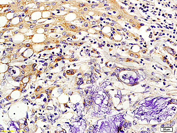 Formalin-fixed and paraffin embedded human colon cancer labeled with Rabbit Anti-Kiss 1/Kisspeptin Polyclonal Antibody (bs-0749R), Unconjugated 1:200 followed by conjugation to the secondary antibody and DAB staining.