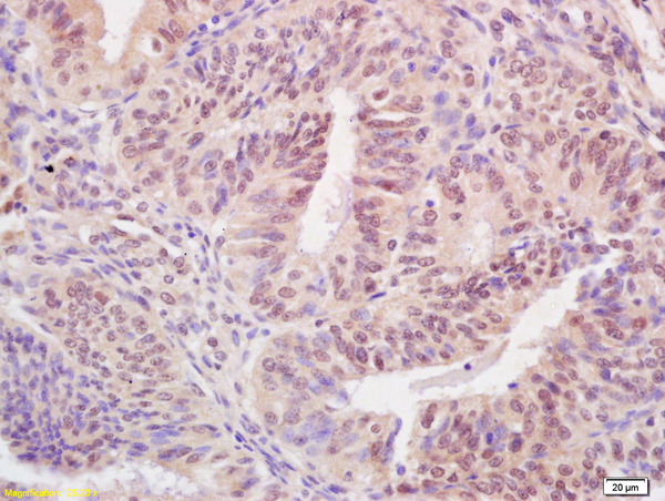 Formalin-fixed and paraffin embedded human breast carcinoma labeled with Rabbit Anti BARD1 Polyclonal Antibody, Unconjugated (bs-4291R) at 1:200 followed by conjugation to the secondary antibody and DAB staining