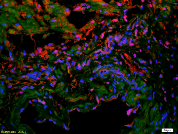 Formalin-fixed and paraffin-embedded human colon carcinoma labeled with Anti-VE Cadherin/VECD/CD144 Polyclonal Antibody, Unconjugated(bs-4310R) 1:200, overnight at 4°C, The secondary antibody was Goat Anti-Rabbit IgG, Cy3 conjugated(bs-0295G-Cy3)used at 1:200 dilution for 40 minutes at 37°C.DAPI was used to stain the cell nuclei