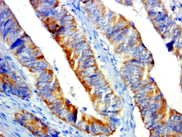 Paraformaldehyde-fixed, paraffin embedded human colon cancer; Antigen retrieval by boiling in sodium citrate buffer (pH6.0) for 15min; Block endogenous peroxidase by 3% hydrogen peroxide for 20 minutes; Blocking buffer (normal goat serum) at 37°C for 30min; Antibody incubation with GPR31 Polyclonal Antibody, Unconjugated (bs-13530R) at 1:500 overnight at 4°C, followed by a conjugated secondary for 20 minutes and DAB staining.