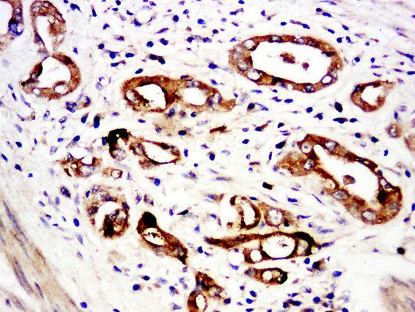 Paraformaldehyde-fixed, paraffin embedded human stomach cancer; Antigen retrieval by boiling in sodium citrate buffer (pH6.0) for 15min; Block endogenous peroxidase by 3% hydrogen peroxide for 20 minutes; Blocking buffer (normal goat serum) at 37°C for 30min; Antibody incubation with\tC6orf52 Polyclonal Antibody, Unconjugated (bs-15248R) at 1:5000 overnight at 4°C, followed by a conjugated secondary for 20 minutes and DAB staining.