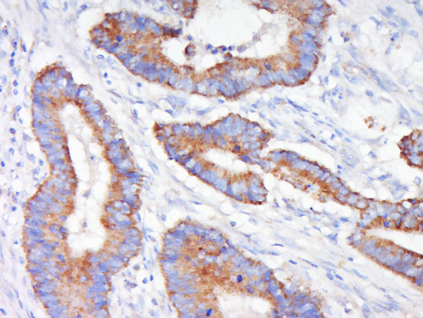 Paraformaldehyde-fixed, paraffin embedded human colon cancer; Antigen retrieval by boiling in sodium citrate buffer (pH6.0) for 15min; Block endogenous peroxidase by 3% hydrogen peroxide for 20 minutes; Blocking buffer (normal goat serum) at 37°C for 30min; Antibody incubation with MEK1 Polyclonal Antibody, Unconjugated (bs-1433R) at 1:500 overnight at 4°C, followed by a conjugated secondary for 20 minutes and DAB staining.