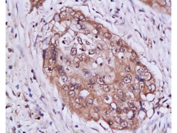 Formalin-fixed and paraffin embedded human cervical tissue labeled with Anti-STAT3 Polyclonal Antibody (bs-1141R), Unconjugated at 1:200 followed by conjugation to the secondary antibody, (SP-0023), and DAB staining