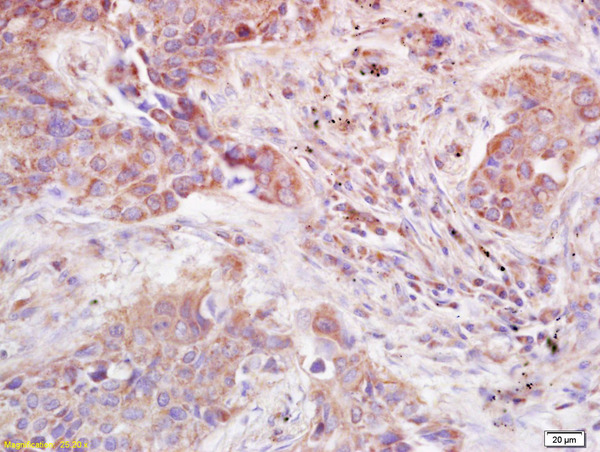 Formalin-fixed and paraffin embedded human lung carcinoma labeled with Anti-ADAMTS12 Polyclonal Antibody, Unconjugated (bs-1385R) at 1:200 followed by conjugation to the secondary antibody and DAB staining.