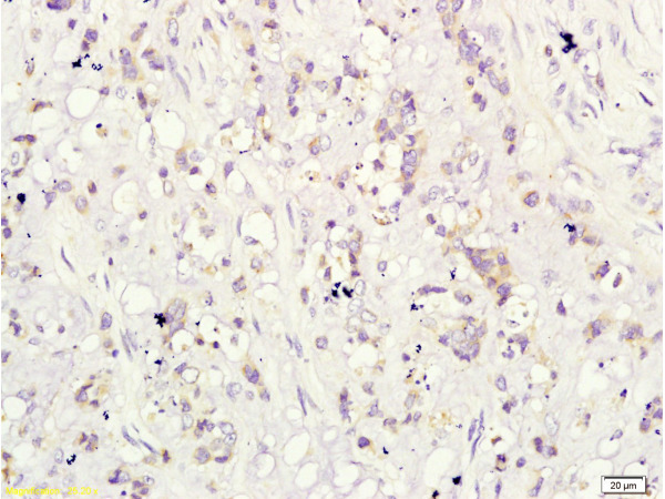 Formalin-fixed and paraffin-embedded human cervical carcinoma labeled with Rabbit Anti-CD160\/By55 Polyclonal Antibody ( bs-2526R), Unconjugated at 1:200 followed by conjugation to the secondary antibody and DAB staining