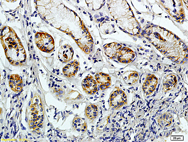 Formalin-fixed and paraffin embedded human colon carcinoma labeled with Rabbit Anti-JAK2 Polyclonal Antibody (bs-0980R), Unconjugated 1:200 followed by conjugation to the secondary antibody and DAB staining