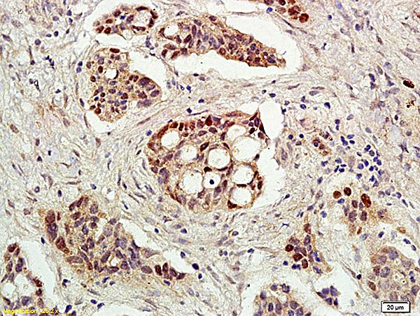 Formalin-fixed and paraffin embedded human ovarian cancer tissue labeled with Rabbit Anti-Acetyl-p53(K382) Polyclonal Antibody (bs-0905R), Unconjugated followed by conjugation to the secondary antibody and DAB staining