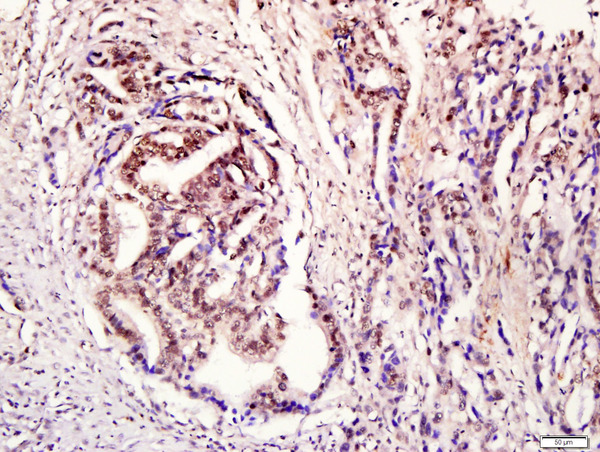 Paraformaldehyde-fixed, paraffin embedded human stomach cancer tissue; Antigen retrieval by boiling in sodium citrate buffer(pH6) for 15min; Block endogenous peroxidase by 3% hydrogen peroxide for 30 minutes; Blocking buffer (normal goat serum) at 37°C for 20min; Antibody incubation with Rabbit Anti-STAT3 (Tyr705) Polyclonal Antibody, Unconjugated (bs-1658R) at 1:400 overnight at 4°C, followed by a conjugated secondary and DAB staining