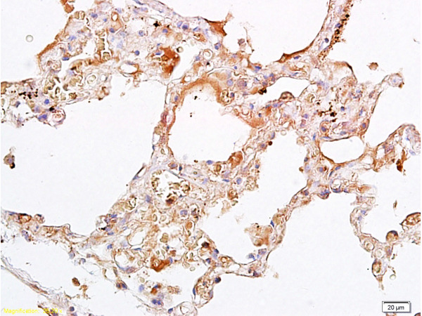 Formalin-fixed and paraffin embedded Human osteosarcoma labeled with Rabbit Anti-Oct-4\/POU5F1 Polyclonal Antibody, Unconjugated  (bs-0830R)  1:300 followed by conjugation to the secondary antibody and DAB staining.