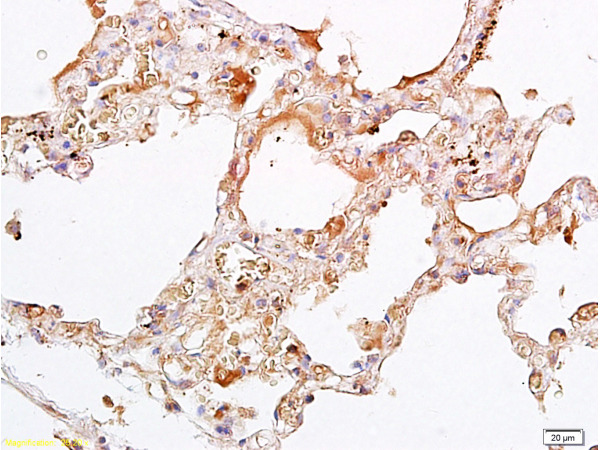 Formalin-fixed and paraffin embedded Human osteosarcoma labeled with Rabbit Anti-Oct-4/POU5F1 Polyclonal Antibody, Unconjugated (bs-0830R) 1:300 followed by conjugation to the secondary antibody and DAB staining.