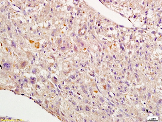 Formalin-fixed and paraffin embedded human endometrial cancer labeled with Rabbit Anti-Nrf2 Polyclonal Antibody, Unconjugated (bs-1074R) 1:200 followed by conjugation to the secondary antibody and DAB staining