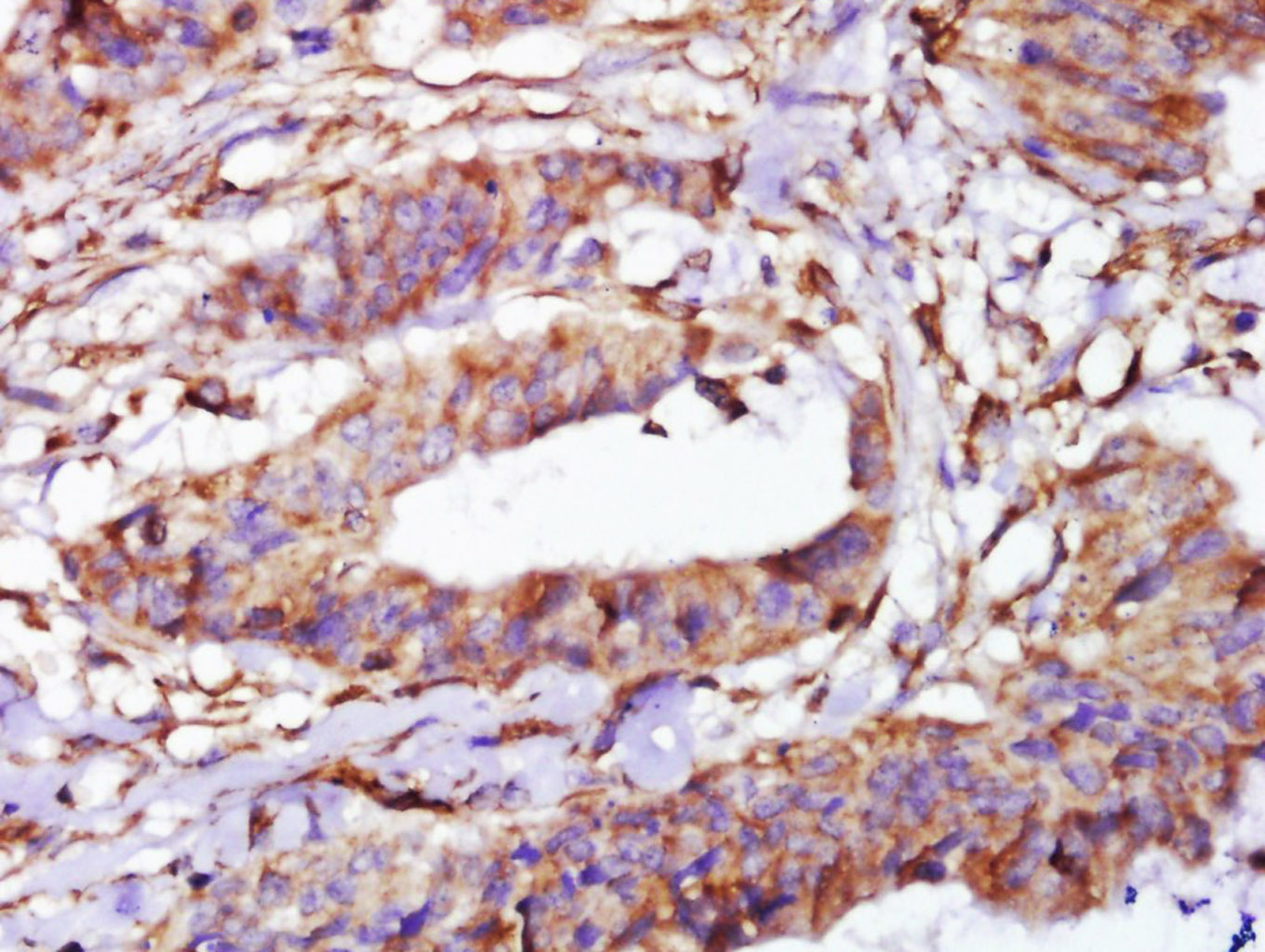 Paraformaldehyde-fixed, paraffin embedded Human cervical carcinoma tissue; Antigen retrieval by boiling in sodium citrate buffer(pH6) for 15min; Block endogenous peroxidase by 3% hydrogen peroxide for 30 minutes; Blocking buffer (normal goat serum) at 37°C for 20min; Antibody incubation with alpha Tubulin (4G1) monoclonal Antibody, Unconjugated (bsm-50179M) at 1:500 overnight at 4°C, followed by a conjugated secondary and DAB staining