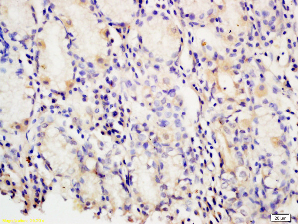 Formalin-fixed and paraffin embedded human gastric carcinoma tissue labeled with Anti-PAF Polyclonal Antibody, Unconjugated(bs-1119R) at 1:200 followed by conjugation to the secondary antibody and DAB staining