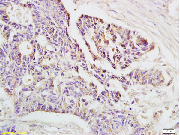 Formalin-fixed and paraffin-embedded human rectal carcinoma labeled with Rabbit Anti-HLA-E Polyclonal Antibody (bs-1279R), Unconjugated at 1:200 followed by conjugation to the secondary antibody and DAB staining