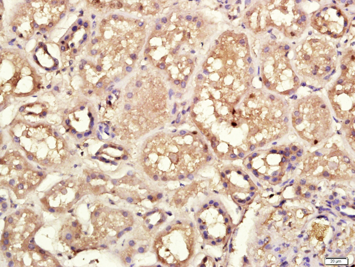 Paraformaldehyde-fixed, paraffin embedded Human kidney; Antigen retrieval by boiling in sodium citrate buffer (pH6.0) for 15min; Block endogenous peroxidase by 3% hydrogen peroxide for 20 minutes; Blocking buffer (normal goat serum) at 37°C for 30min; Antibody incubation with CECR1 Polyclonal Antibody, Unconjugated (bs-9005R) at 1:400 overnight at 4°C, followed by a conjugated secondary antibody for 20 minutes and DAB staining.