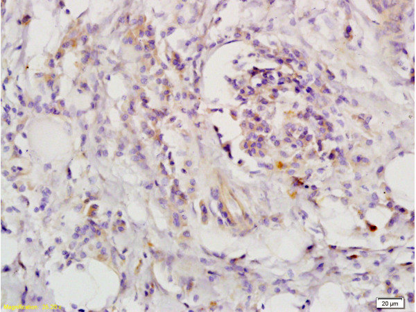 Formalin-fixed and paraffin-embedded human colon carcinoma labeled with Rabbit Anti-CD118 Polyclonal Antibody (bs-1458R), Unconjugated 1:200 followed by conjugation to the secondary antibody and DAB staining Formalin-fixed and paraffin-embedded human colon carcinoma labeled with Rabbit Anti-CD118 Polyclonal Antibody (bs-1458R), Unconjugated 1:200 followed by conjugation to the secondary antibody and DAB staining