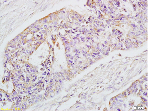 Formalin-fixed and paraffin-embedded human rectal carcinoma labeled with Rabbit Anti-EpCAM Polyclonal Antibody (bs-1513R), Unconjugated 1:200 followed by conjugation to the secondary antibody and DAB staining