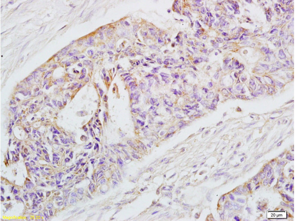 Formalin-fixed and paraffin-embedded human rectal carcinoma labeled with Rabbit Anti-EpCAM Polyclonal Antibody (bs-1513R), Unconjugated 1:200 followed by conjugation to the secondary antibody and DAB staining Formalin-fixed and paraffin-embedded human rectal carcinoma labeled with Rabbit Anti-EpCAM Polyclonal Antibody (bs-1513R), Unconjugated 1:200 followed by conjugation to the secondary antibody and DAB staining