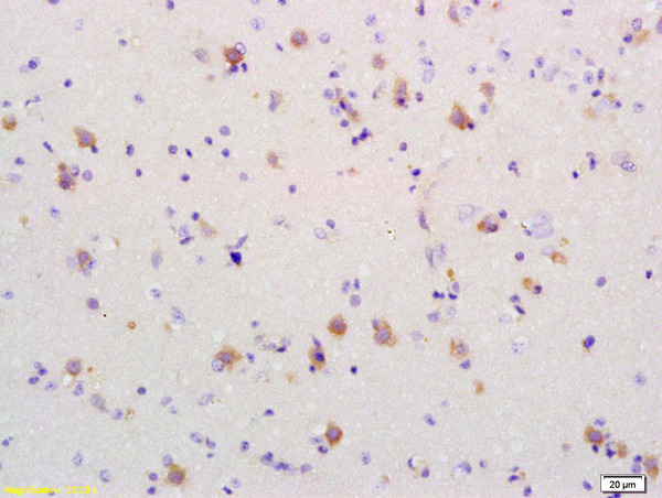 Formalin-fixed and paraffin embedded human brain glioblastoma labeled Anti-PDCD4 Polyclonal Antibody, Unconjugated (bs-1608R) at 1:200, followed by conjugation to the secondary antibody and DAB staining