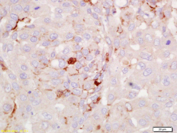 Formalin-fixed and paraffin embedded human lung carcinoma labeled with Anti-RGS2 Polyclonal Antibody, Unconjugated (bs-0492R) at 1:200 followed by conjugation to the secondary antibody and DAB staining.