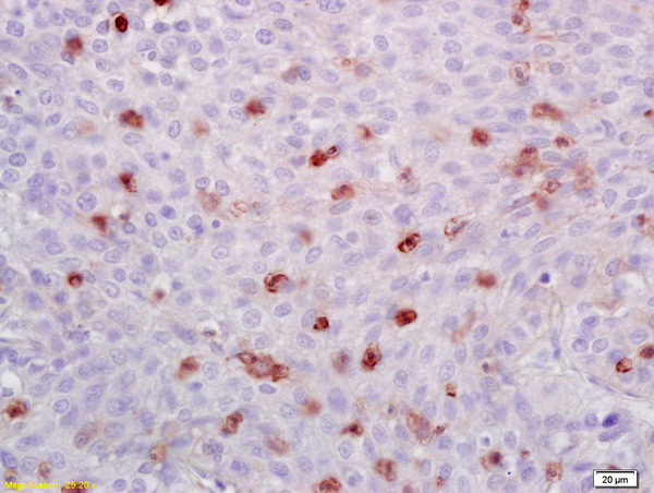 Formalin-fixed and paraffin embedded human lung carcinoma labeled with Anti-ATF1 Polyclonal Antibody, Unconjugated (bs-0517R) at 1:200 followed by conjugation to the secondary antibody and DAB staining.
