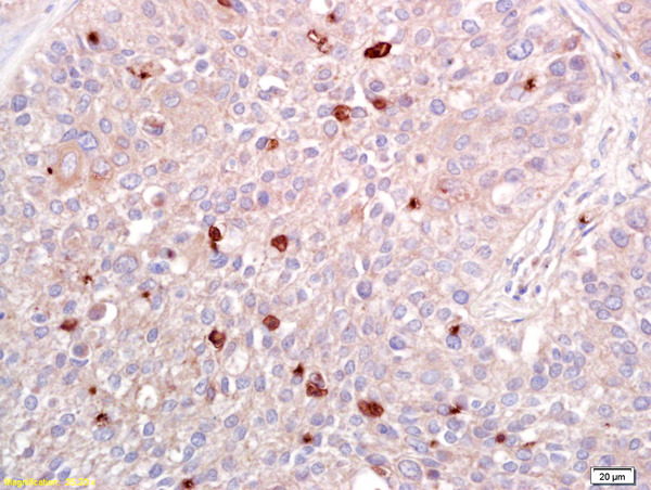 Formalin-fixed and paraffin embedded human lung carcinoma labeled with Anti-ATF2 Polyclonal Antibody, Unconjugated (bs-0518R) at 1:200 followed by conjugation to the secondary antibody and DAB staining.