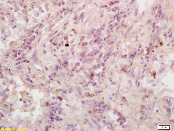 Formalin-fixed and paraffin embedded human lung carcinoma labeled with Anti-RASSF1A Polyclonal Antibody, Unconjugated (bs-1234R) at 1:200 followed by conjugation to the secondary antibody and DAB staining.