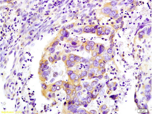 Formalin-fixed and paraffin-embedded : human colon carcinoma labeled with Rabbit Anti-WNK3 protein Polyclonal Antibody (bs-1945R), Unconjugated 1:200 followed by conjugation to the secondary antibody