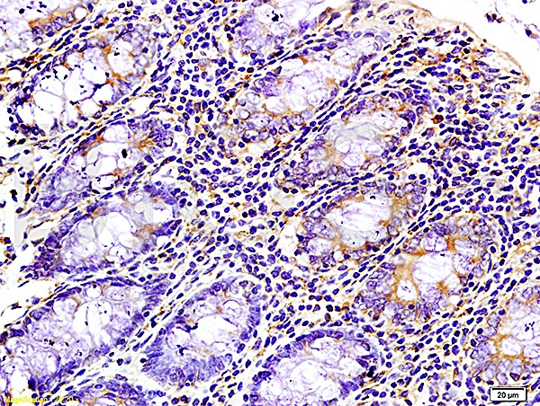 Formalin-fixed and paraffin-embedded : human colon carcinoma labeled with Rabbit Anti-WNK3 protein Polyclonal Antibody (bs-1945R), Unconjugated 1:200 followed by conjugation to the secondary antibody