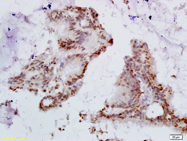 Formalin-fixed and paraffin embedded human colon carcinoma tissue labeled Anti-HPV16 E6 + HPV18 E62 Polyclonal Antibody, Unconjugated (bs-1719R) at 1:200, followed by conjugation to the secondary antibody and DAB staining