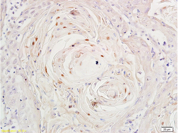 Formalin-fixed and paraffin-embedded human cervical carcinoma labeled with Rabbit Anti-Ki-67 Polyclonal Antibody, Unconjugated(bs-2130R) at 1:200 followed by conjugation to the secondary antibody and DAB staining