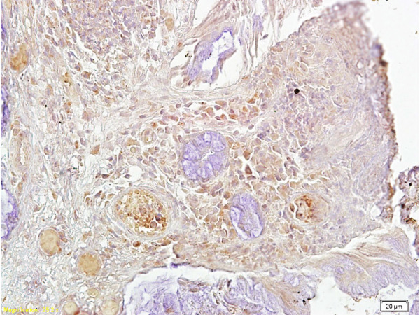 Formalin-fixed and paraffin-embedded human oral squamous cell carcinoma labeled with Rabbit Anti-Ki-67 Polyclonal Antibody, Unconjugated(bs-2130R) at 1:200 followed by conjugation to the secondary antibody and DAPI staining