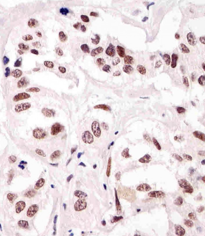 Paraformaldehyde-fixed, paraffin embedded human breast carcinoma tissue; Antigen retrieval by boiling in sodium citrate buffer (pH6.0) for 15min; Block endogenous peroxidase by 3% hydrogen peroxide for 15 minutes; Blocking buffer (3% BSA) at room temperature for 30min; Antibody incubation with SUMO1 (66AT1273.94) Monoclonal Antibody (bsm-51020M) at 1:25 for 1 hour at 37°C, followed by a conjugated secondary antibody for 20 minutes and DAB staining.