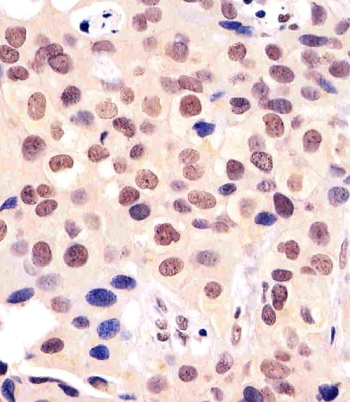 Paraformaldehyde-fixed, paraffin embedded human breast carcinoma; Antigen retrieval by boiling in sodium citrate buffer (pH6.0) for 15min; Block endogenous peroxidase by 3% hydrogen peroxide for 15 minutes; Blocking buffer (3% BSA) at room temperature for 30min; Antibody incubation with BANP (4C2) Monoclonal Antibody (bsm-51349M) at 1:25 for 1 hour at 37°C, followed by a conjugated secondary antibody for 20 minutes and DAB staining.